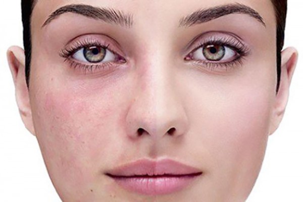 couperose-make-up.jpg