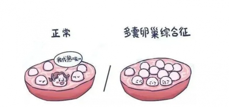 深圳孕宝国际：多囊卵巢如何治疗？一定要做试管婴儿吗？