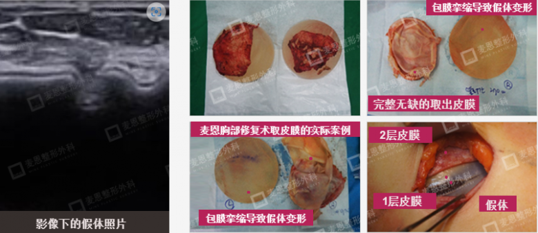 韩国麦恩整形外科隆胸是否会有副作用