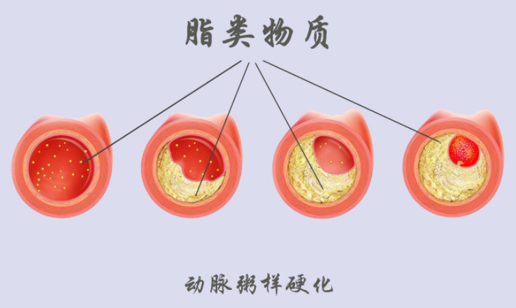 潓美氢氧机：氢氧促进血液流动VS动脉粥样硬化