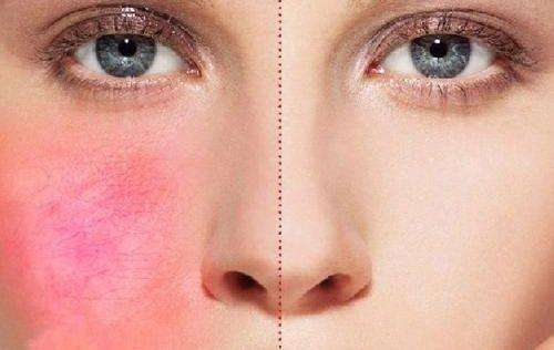 2020年夏天来了敏感肌肤要如何自救