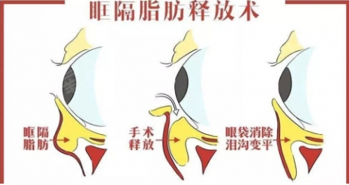 北京好年华：眶隔脂肪释放与吸脂有什么不同