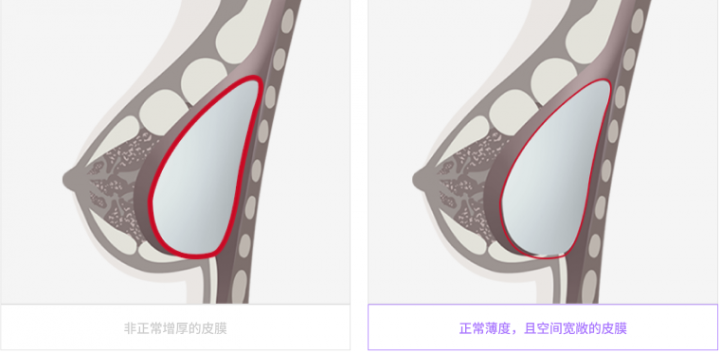 麦恩整形外科告诉你胸部包膜挛缩：你需要知道的一切